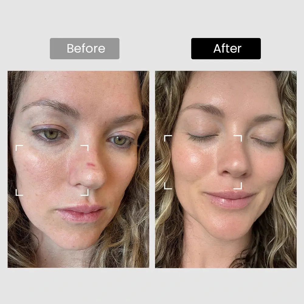 DermRays Revive Skincare Laser for Anti-Aging, Glow Like Never Before