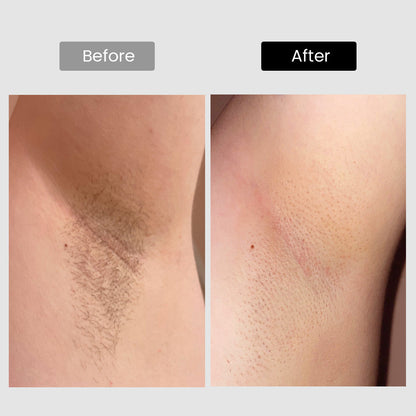DermRays V8S *Enhanced Edition* Diode Laser Hair Removal, Pro-level cooling, Target Thick Hair with Precision