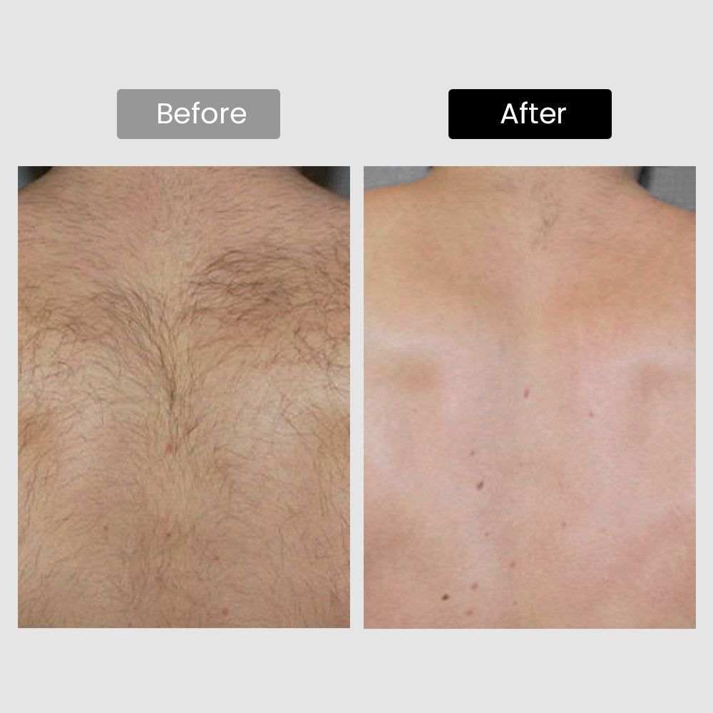 DermRays V8S *Enhanced Edition* Diode Laser Hair Removal, Pro-level cooling, Target Thick Hair with Precision