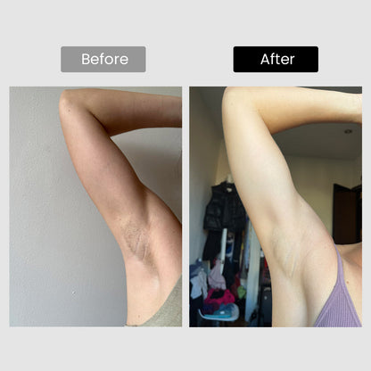 DermRays V4S Diode Laser Hair Removal, 810nm, Specifically For Sensitive Skin